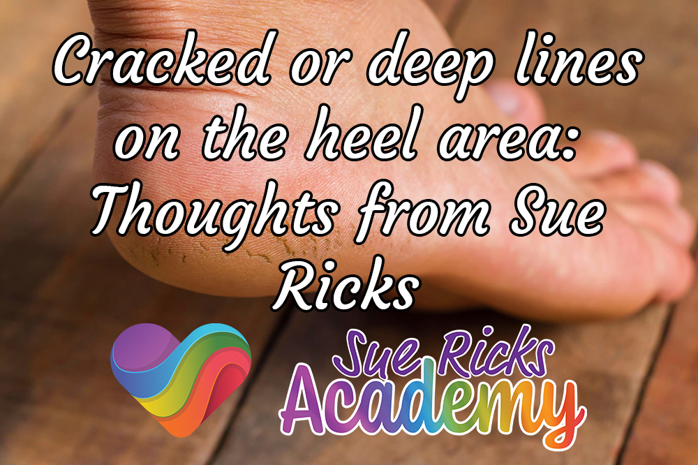 Cracked or deep lines on the heel area - Thoughts from Sue Ricks